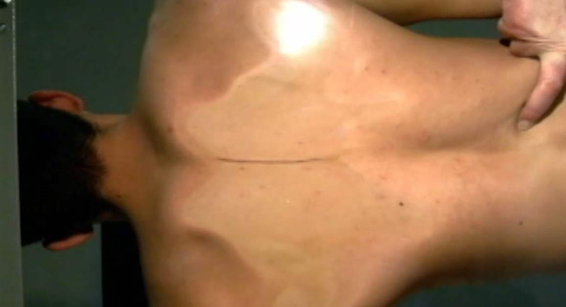 59. Anne Wales Technique for-the-11th-and-12th Rib